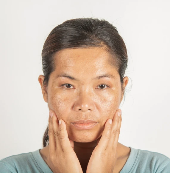 Asian-woman-with-hyperpigmentation-page