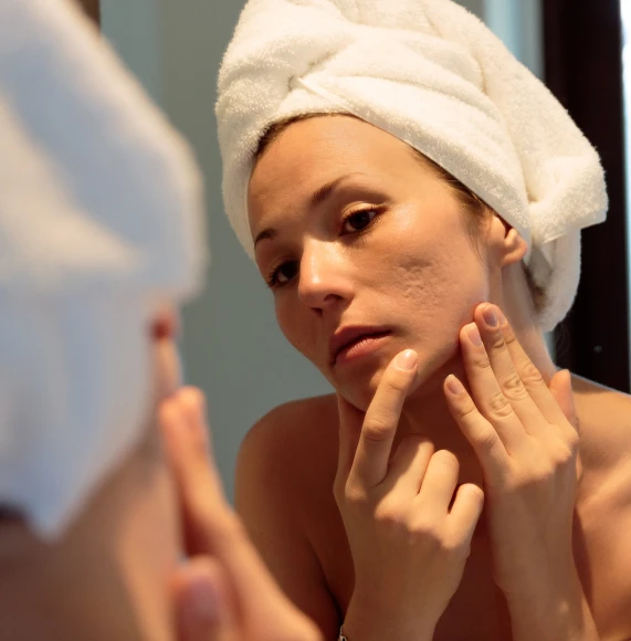 Girl-with-towel-on-head-Acne-Scars-Page