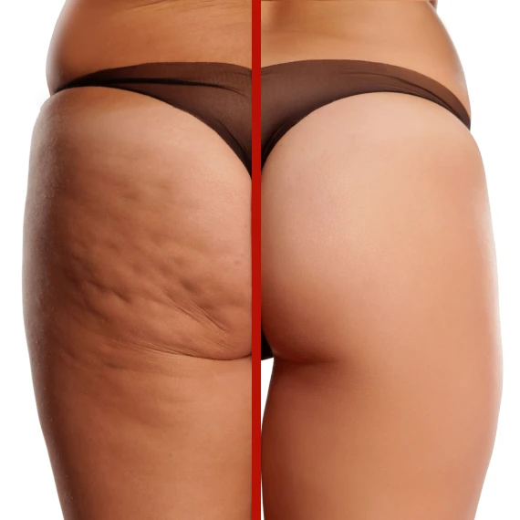 before-after-cellulite-on-buttocks