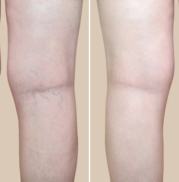 before-after-leg-vein-reduction-body-page