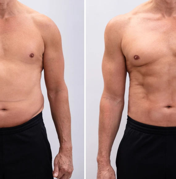 male-before-after-weightloss-vertical