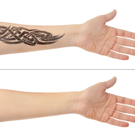 man-arm-tattoo-removal-before-after