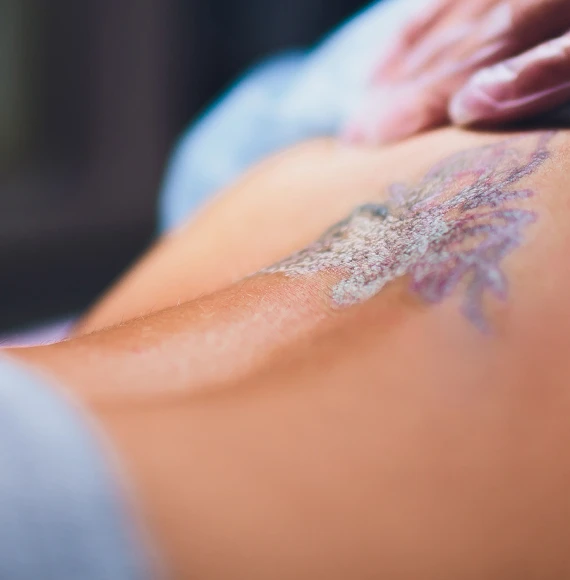 4 Reasons to Consider Laser Treatments for Removing Unwanted Tattoos   Laser NY